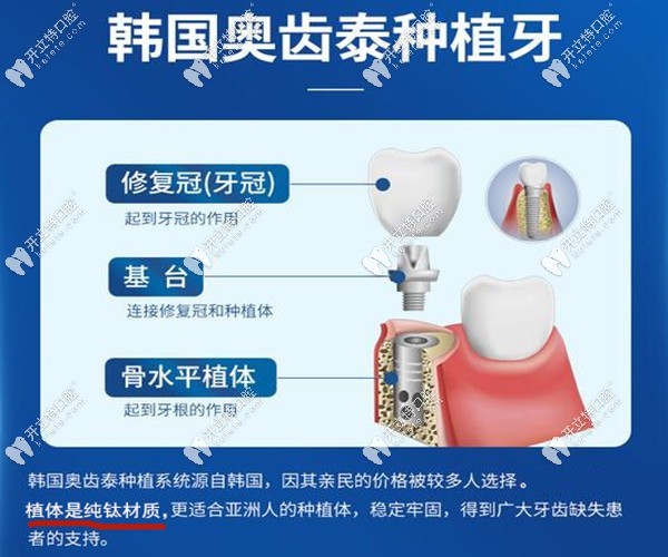 深圳正恩口腔韓國奧齒泰種植牙