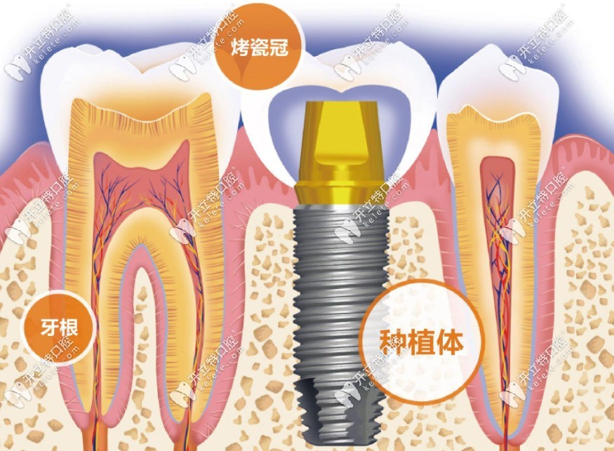奥齿泰种植牙的优缺点