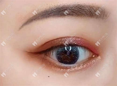 做韓國(guó)登騰種植體+牙冠的總費(fèi)用竟才3千多，還能質(zhì)保5年呢