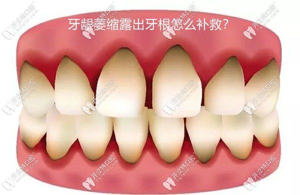 牙齦萎縮露出牙根怎么補救