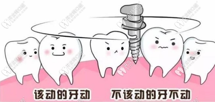正畸打骨釘需要另外收費(fèi)嗎