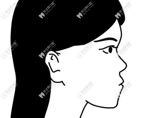 凸嘴側(cè)臉難看