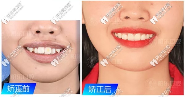 齙牙隱適美矯正案例