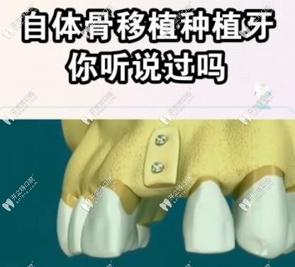 牙槽骨骨量不足自體骨移植