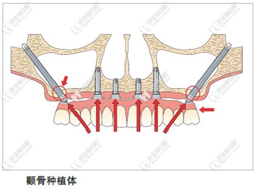 牙槽骨骨量不足的種植方法四：顴骨種植術