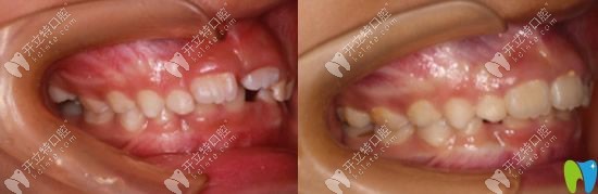 5歲男孩牙列不齊在廣州圣貝口腔做MRC肌功能矯正案例