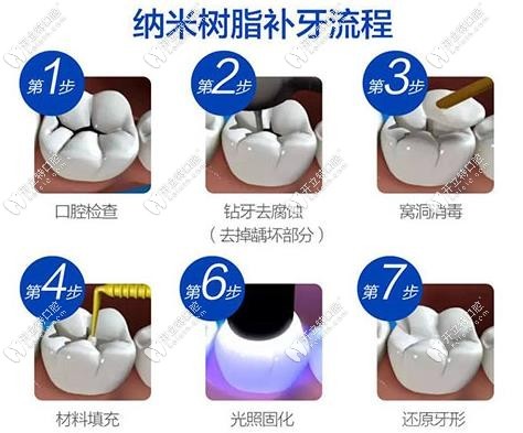 樹脂補(bǔ)牙流程