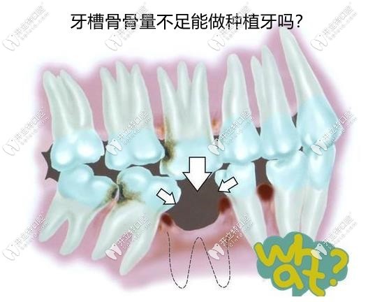 牙槽骨骨量不足的種植方式