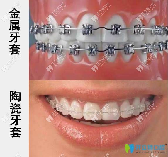金屬牙套與陶瓷牙套的區(qū)別示意圖