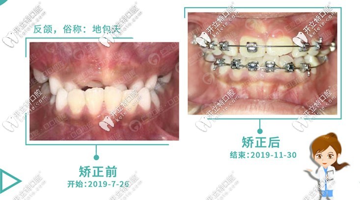 兒童地包天矯正前后效果圖
