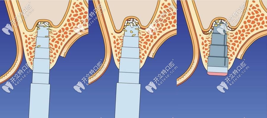 牙槽骨骨量不足的修復方式三：上頜竇提升術