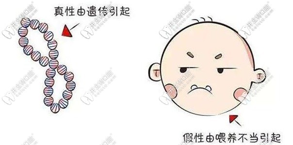 地包天一般由遺傳與不良習(xí)慣導(dǎo)致