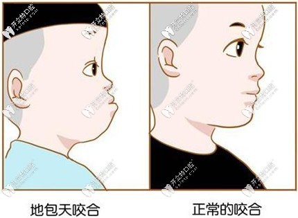 地包天與正常的咬合區(qū)別