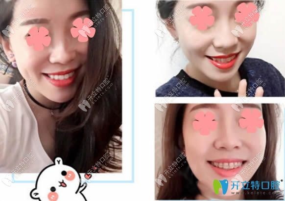 陶瓷半隱形牙齒矯正對比效果