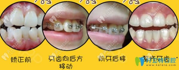 金屬托槽牙齒矯正過程圖