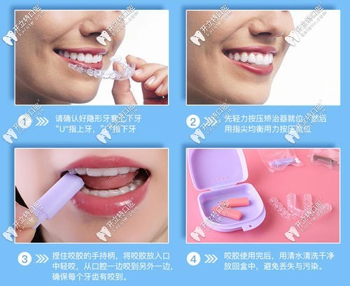 正畸咬膠使用方法