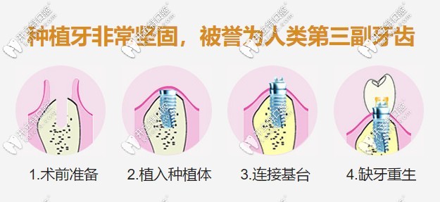 種植牙簡單流程