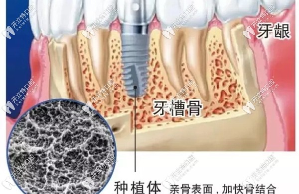 種植體在牙槽骨內(nèi)的圖