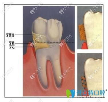 什么是牙結(jié)石