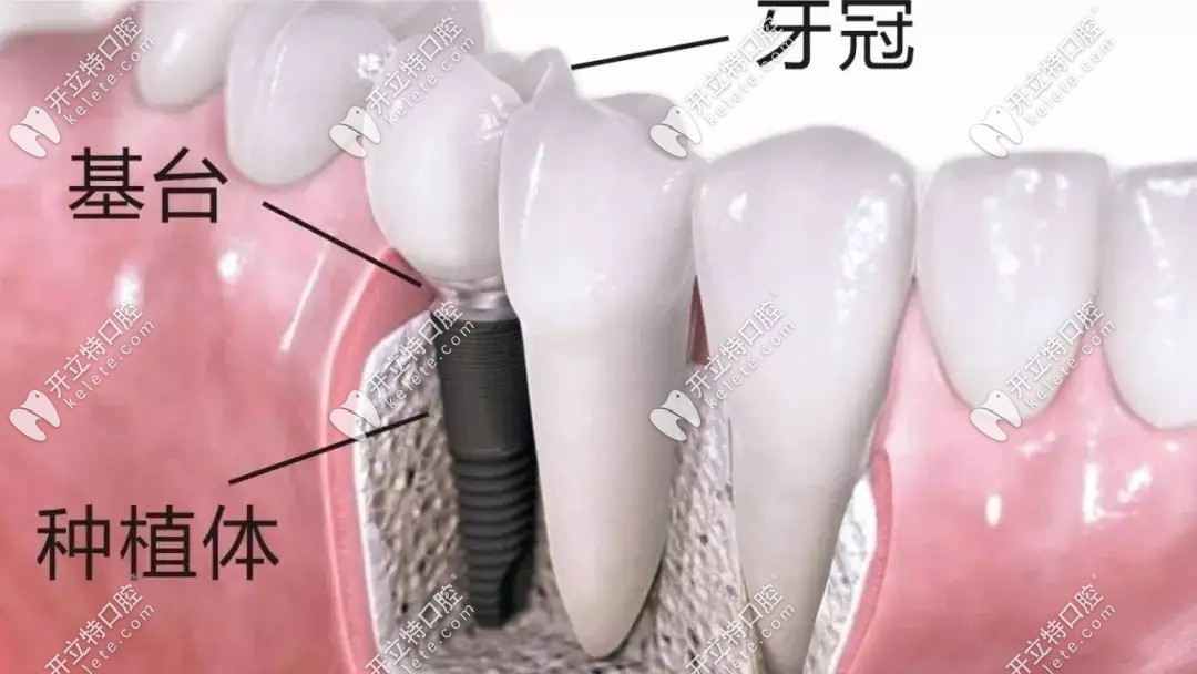 種植牙結(jié)構(gòu)示意圖