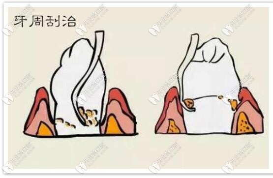 齦下刮治是治療牙周疾病的方法之一