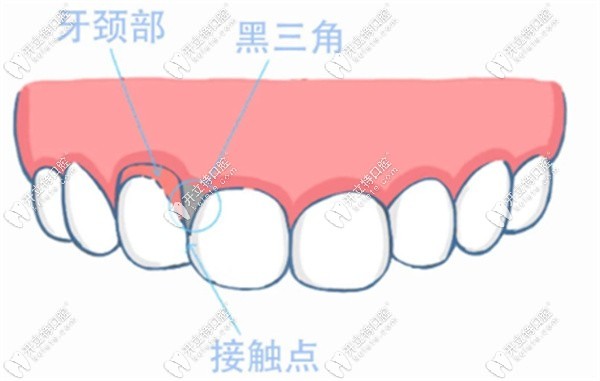 牙齒黑三角產生的原因有哪些