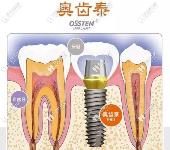 韓國奧齒泰進口種植牙怎么樣