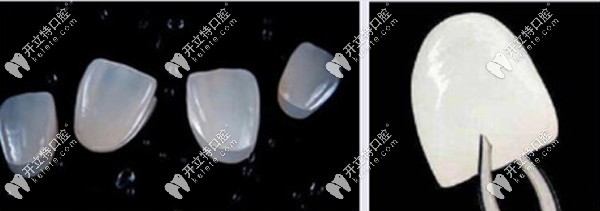 义获嘉瓷贴面的优点