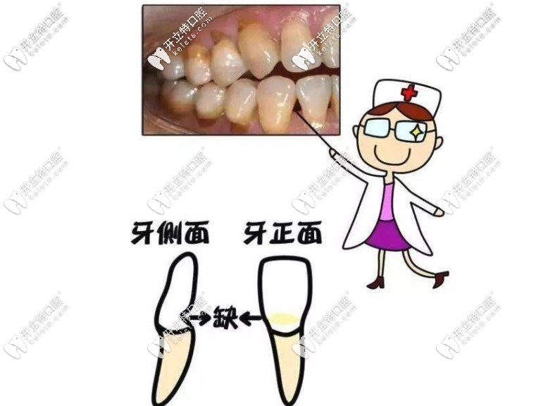 牙齿楔状缺损
