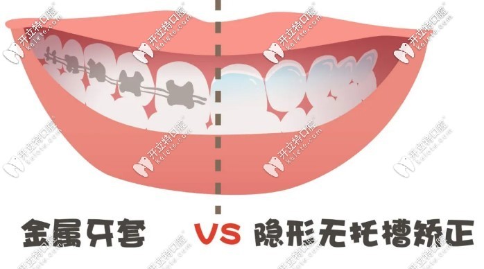金屬牙套和隱形牙套的圖片