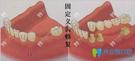 南京美奧口腔固定義齒修復(fù)圖