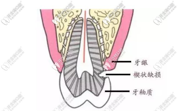 什么是楔状缺损