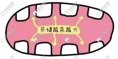 我的牙縫過(guò)大選擇全瓷牙修復(fù)