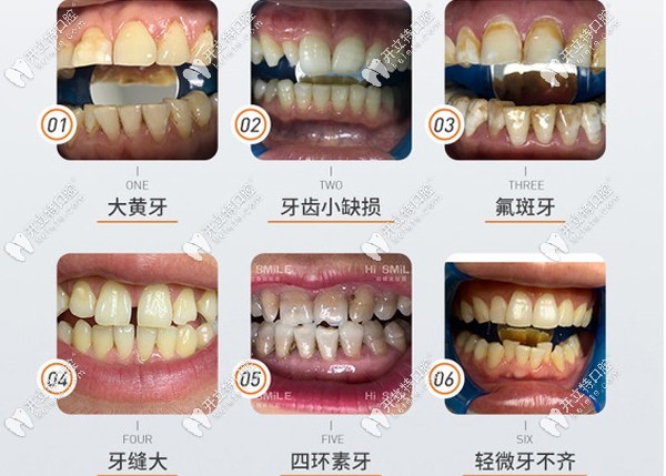 义获嘉瓷贴面的适应症