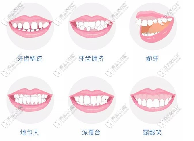牙齿矫正的适应症