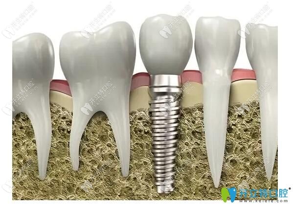 種植體品牌不同價(jià)格也不同