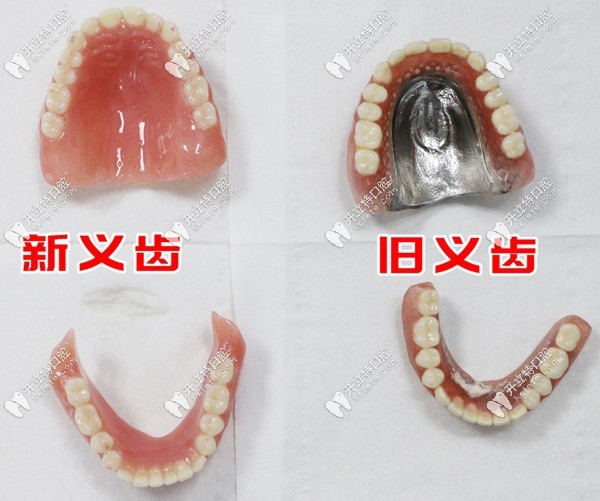 BPS吸附性義齒的優(yōu)缺點