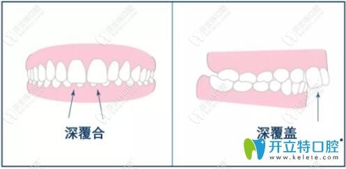 深覆合和深覆蓋有什么區(qū)別