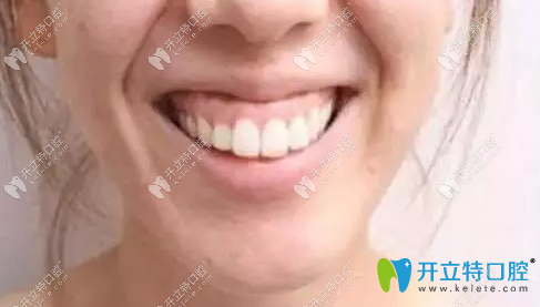 深覆合露齦笑