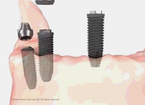 種植牙動(dòng)圖