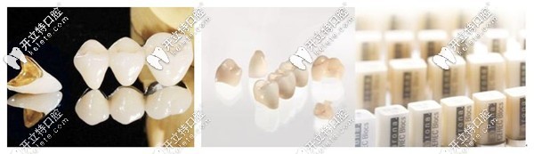 烤瓷牙和瓷?？掏庥^對比圖
