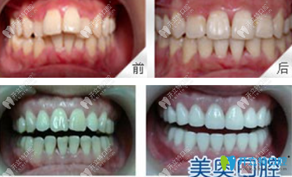 美奧口腔齙牙矯正+牙齒美容修復(fù)效果案例