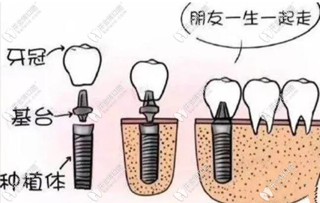 種植牙組成