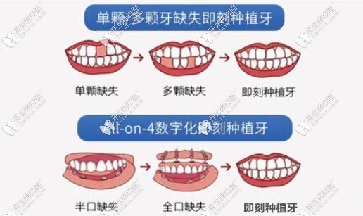 佳美口腔種植牙技術