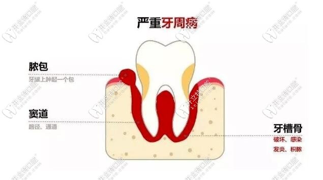 瘺管已經(jīng)發(fā)展到牙周問(wèn)題