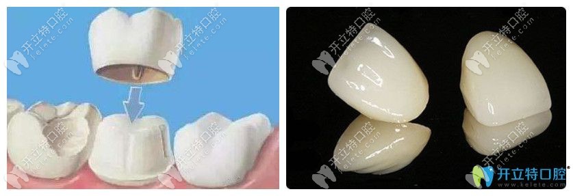 全瓷牙基牙爛掉怎么辦