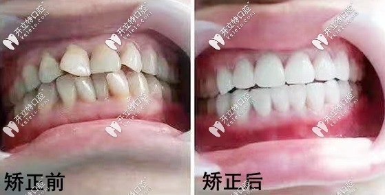 海口华美口腔的矫正案例
