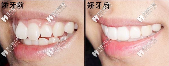 <!--<i data=20240703-sp></i>-->齿科矫正案例
