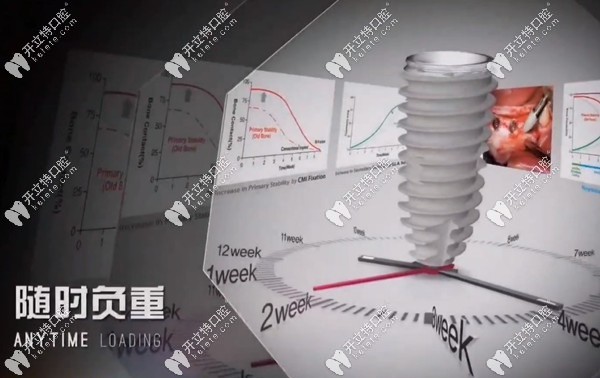韓國(guó)紐百特種植體