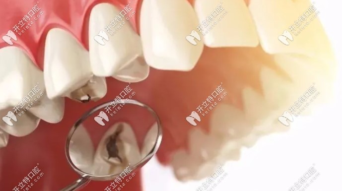 完整的牙根拔掉后對(duì)我們會(huì)有什么影響